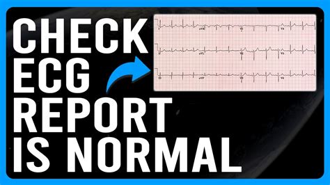 how to check ecg report.
